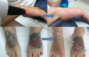 Máquina de depilación de electrólisis portátil con láser Qswitch 755/1320nm/1064nm para rejuvenecimiento de la piel facial láser de eliminación de tatuajes - Product Image 4