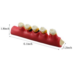 Modelo de Dientes Tipodonto para Demostración del Progreso de la Enfermedad Periodontal, Categoría Patología, para Enseñanza, Estudio y Demostración - Product Image 2