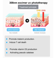 Mini 308nm UVB Photothérapie Psoriasis Excimer Laser 308 nm UVB Lampe Système Équipement Traitement Du Vitiligo Et Traitement De L'eczéma