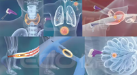 Système d'ablation par micro-ondes médical 2026 pour le traitement des tumeurs, puissance 60W, écran 7 pouces, garantie 1 an, certifié CE