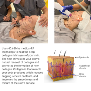 Không xâm lấn da thắt chặt chống-wirnkles nhiệt nâng fractional-<span class=keywords><strong>Radio</strong></span>-Tần số <span class=keywords><strong>40.68MHz</strong></span>-RF máy cho khuôn mặt cơ thể làm săn chắc - Product Image 2