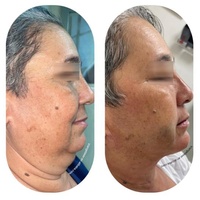 Appareil de liposuccion populaire 2026 pour l'élimination de la graisse corporelle, lipolyse endolaser, lifting du visage, laser 1470 980nm