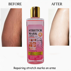 Aceite Reparador de Estrías, Aceite Reparador <span class=keywords><strong>para</strong></span> Madres, Vitamina E, Ácido Kójico, 4x Más Eficaz, Aceite Antiarrugas <span class=keywords><strong>para</strong></span> una Piel Suave, <span class=keywords><strong>para</strong></span> Cuerpo y Rostro, Venta al por Mayor - Product Image 3