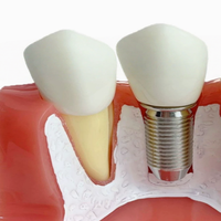 Modèle de démonstration d'implant dentaire Premium 4X avec couronne et pont amovibles pour cliniques et écoles dentaires