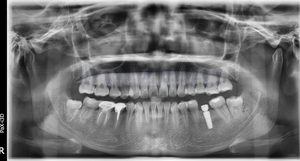 Kullanılmış Vatech PaX-i3D 3D Tanı Panoramik Diş Röntgeni 3'ü 1 Arada Pano CBCT Ceph Dijital Opg Cihazı - Product Image 6