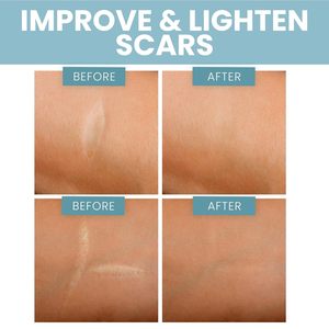 هلام السيليكون رقعة الندبات غير مرئية لون البشرة لاصقة الجمال للفم والأنف والجسم غطاء ندبة فرط اللصق - Product Image 5