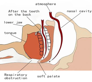 Dilatador Nasal Anti-Ronquidos y Protector Bucal, Solución para la Apnea del Sueño, 100% Silicona de Grado Alimenticio, Dispositivo de Cuidado de la Salud Ecológico - Product Image 5
