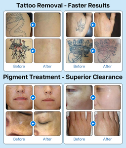 <span class=keywords><strong>Meilleur</strong></span> système de laser Pico à 3 longueurs d'onde 532nm 755nm 1064nm avec bras articulé coréen pour studio de tatouage - Product Image 6