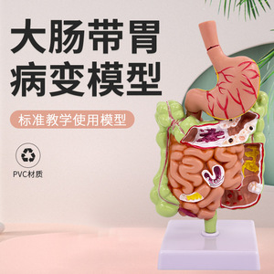 Modèle de simulation pédagogique de la pathologie du côlon humain, des maladies gastro-intestinales, des lésions du côlon, des maladies intestinales, des lésions du côlon - Product Image 2