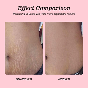 Nhãn Hiệu Riêng Căng Đánh Dấu Loạ<span class=keywords><strong>i</strong></span> Bỏ Kem Mang Thai Phai Dòng Lột Bụng Bơ Cho Mang Thai Căng Đánh Dấu - Product Image 5