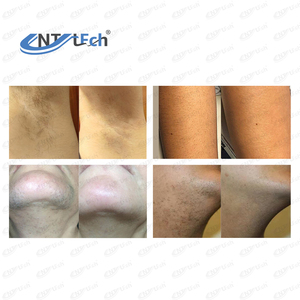 808nm 808 755 1064 cường độ cao ba bước sóng <span class=keywords><strong>Diode</strong></span> Laser 4 trong 1 đứng loại để bán - Product Image 6