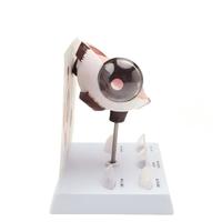 Modèle d'anatomie de l'œil humain agrandi avec 5 types de lentilles pathologiques pour l'enseignement en ophtalmologie