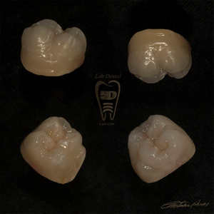 Les techniciens BAOT PFZ ont utilisé des prix de prothèses dentaires en poudre de porcelaine matériaux dentaires pour le traitement Kit de base en céramique <span class=keywords><strong>dentaire</strong></span> en zircone - Product Image 3