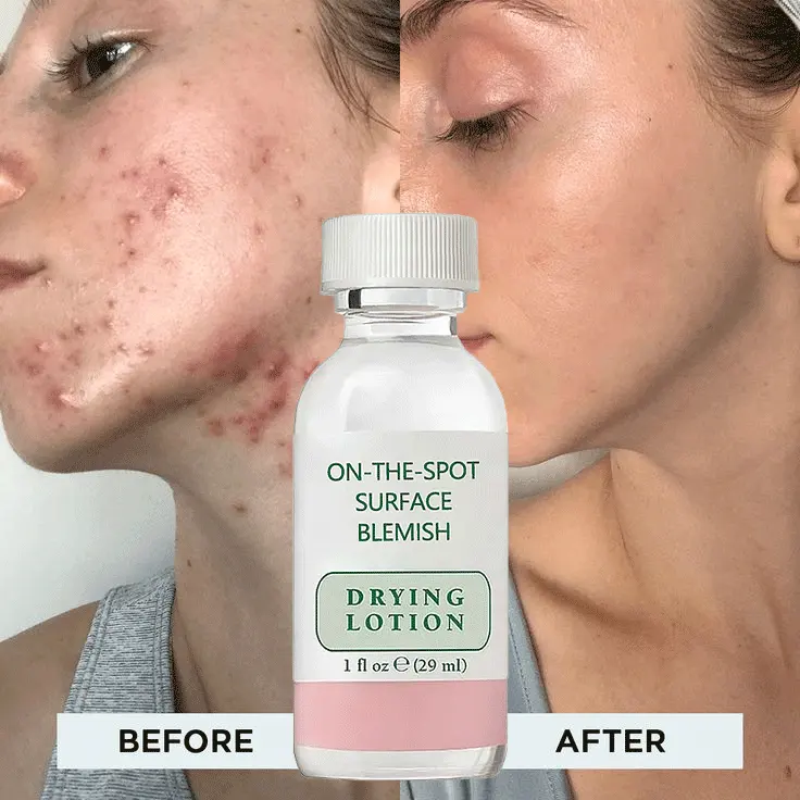 Hete Verkoop Behandeling Acne Gevoelig Voor Gevoelige Huidverzorging Gezichtsserum Tegen Acne, Roodheid Verlichting, Gezichtsserums Drogen Lotion