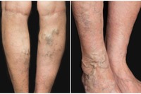 Appareil d'ablation au laser diode EVLT 1470nm pour le traitement des varices endoveineuses / Machine d'élimination des varicosités et des vaisseaux sanguins