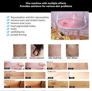 Y tế chứng nhận bán CO2 fractional Laser âm đạo thắt chặt vẻ đẹp thiết bị 10600nm thương mại & nhà sử dụng 40 Wát <span class=keywords><strong>RF</strong></span> điện - Product Image 6