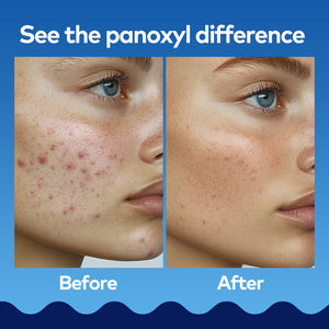 Acne-Vormende Gezichtsreiniger Wassen Gerichte Oplossing Voor Acne Breakout - Product Image 6