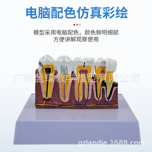 Molares ampliados 3 veces, patología dental completa, dientes transparentes, caries dentales, enseñanza de comunicación con pacientes dentales - Product Image 5