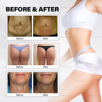 Perfectlaser 6 en 1 Vela, rouleau à vide indolore, IR RF Cavitation, amincissement, modes multiples, raffermissement de la peau, réduction de la graisse, perte de poids