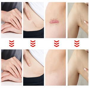 Bande de <span class=keywords><strong>cicatrice</strong></span> en <span class=keywords><strong>silicone</strong></span> de qualité médicale de marque privée bandages de traitement de chéloïde auto-adhésifs bande de <span class=keywords><strong>cicatrice</strong></span> permanente - Product Image 3