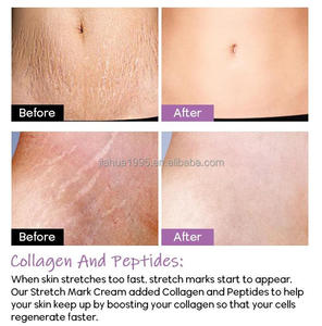 Estompe les cicatrices chirurgicales traitement graisse vergetures crème d'élimination efficace non grasse réparation crème blanchissante - Product Image 5