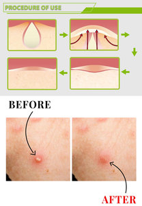 أقنعة وحب الشباب والبثور بحمض الساليسيليك للوجه علامة تجارية خاصة العناية بالبشرة للبشرة المعرضة لحب الشباب وإزالة البقع الداكنة - Product Image 5