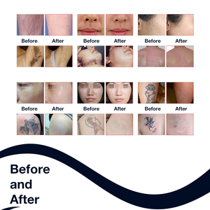 Teknologi Mesin Laser Diode dan Laser Picosecond ND Yag Multifungsi untuk Menghilangkan Tato dan Rambut 2 in 1 - Product Image 5