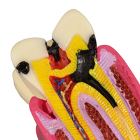 Modelo Educativo de Anatomía de Caries Dentales, Plástico, 6 Secciones Transversales, Demostraciones de Comparación Bilateral, Estudio de Ciencias Médicas