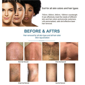 La más nueva máquina de depilación láser de <span class=keywords><strong>Alejandrita</strong></span> de pulso largo para Salón Comercial Lazer de <span class=keywords><strong>Alejandrita</strong></span> 755nm <span class=keywords><strong>en</strong></span> <span class=keywords><strong>casa</strong></span> - Product Image 6