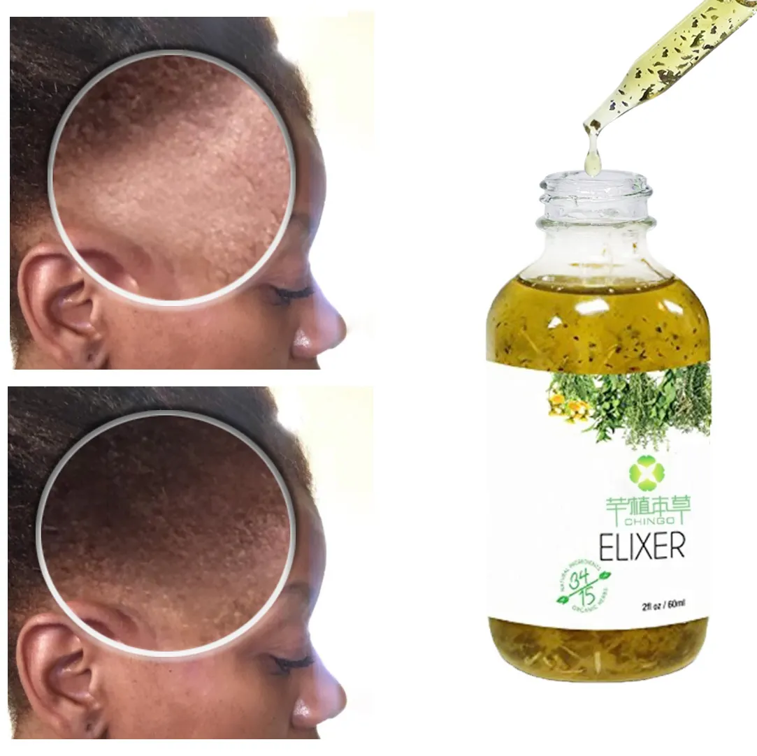 Hair Growth Treatment Hot Sell Private Label 100% Natural Formula Wholesale Nourishing Scalp Elixirs Hair Care Loss Treatment Hair Growth Oil Serum