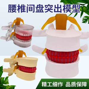 Modelo de columna lumbar, para la demostración médica de la compresión del disco intervertebral lumbar y la patología de osteófitos espinales. - Product Image 5