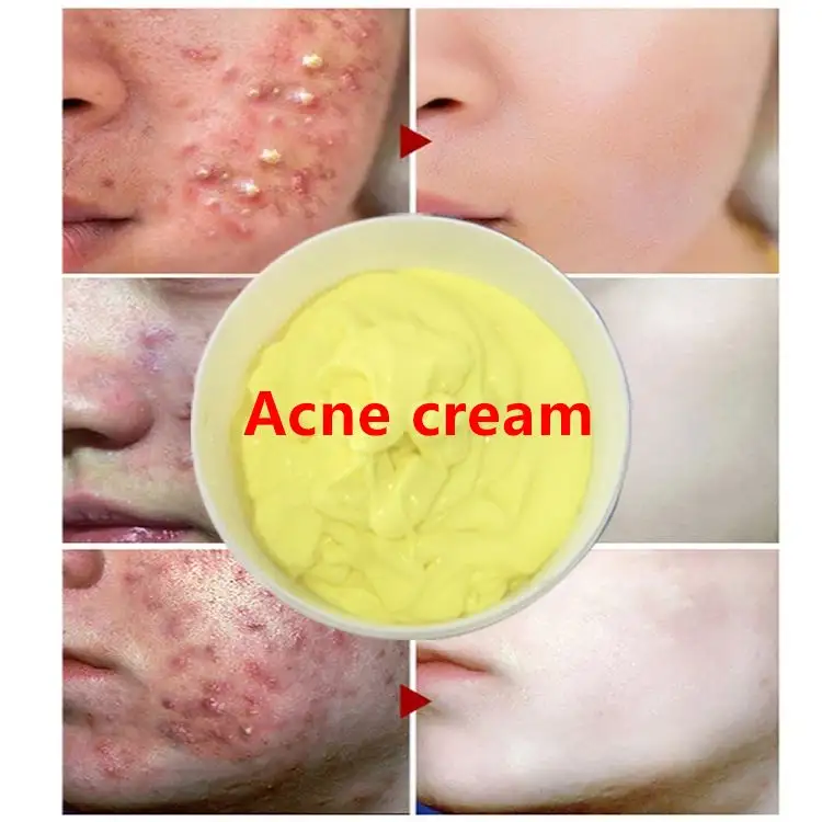 Trattamento dell'acne di alta qualità Kit per la cura della pelle biologico detergente per il viso crema antiacne per l'invecchiamento cura della pelle dell'albero del tè