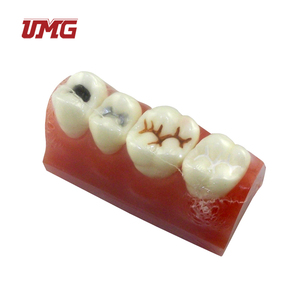 Sealant and <strong>Inlay</strong> Demonstration <strong>Teeth</strong> Model for Patient Education - Product Image 2