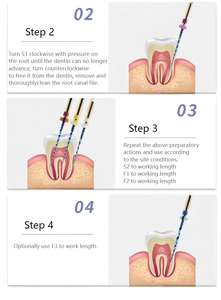 กิน ไฮ คุณภาพสูง นิไท ซุปเปอร์ บลู ฮีท แอคทิเวชั่น SX-F3 #   เครื่องมือเจาะรากฟันขนาด 25 มม. สำหรับใช้กับเครื่อง - Product Image 6