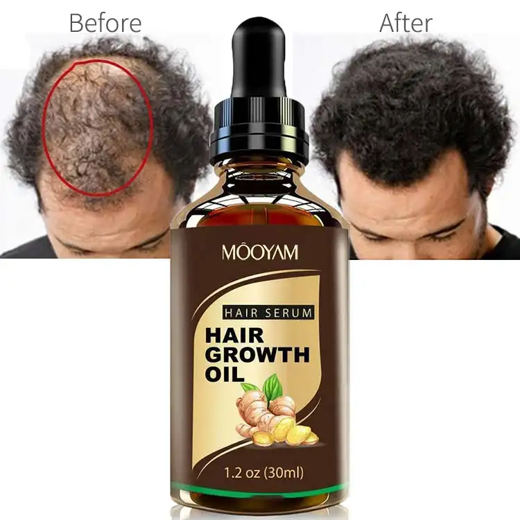 ほとんどの販売されたスカルプ育毛製品は脱毛防止男性を修理します脱毛症のための有機育毛オイル