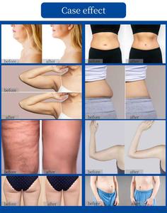 <span class=keywords><strong>Appareil</strong></span> de remodelage corporel par ondes froides <span class=keywords><strong>efficace</strong></span> pour lutter contre le vieillissement, améliorer le relâchement cutané et éliminer le double menton - Product Image 6