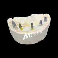 Prothèse dentaire implantée avec piliers en titane et couronne en zircone, fabrication sur mesure CAD/CAM pour cliniques et laboratoires dentaires