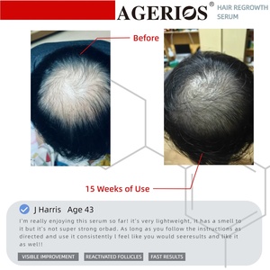 Spray para la Caída del Cabello para Hombres y Mujeres, <span class=keywords><strong>Alopecia</strong></span> Androgénica, Inhibidor de Androgenas al 5%, Bruma Capilar con Jengibre y Menta, Estimula el Crecimiento - Product Image 5