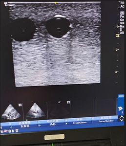 Modelo de Entrenamiento de Maniquí para Cateterización PICC Arteriovenosa Femoral con Punción Vascular Guiada por Ultrasonido, Tamaño Real - Product Image 6