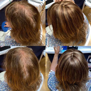 Prótesis de Reemplazo de 7x9 Pulgadas, Base de Poliuretano, Inyección, Piel Fina, <span class=keywords><strong>Natural</strong></span>, Cruda, 6 #   Parche de Cabello Humano Color Marrón para <span class=keywords><strong>Mujer</strong></span> - Product Image 5