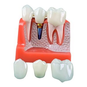 4 volte impianto dentale modello porcellana denti corona rimovibile ponte impiallacciature per la scienza medica studio insegnamento - Product Image 4