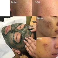 Sérum visage non invasif à base de plantes efficace avec éponge aux algues Microneedles pour le traitement de l'acné et l'élimination des cicatrices Masque crème chaude