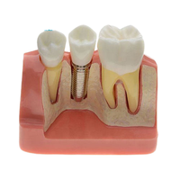Modelo Dental de Enseñanza, Modelo de Estudio de Odontología, Implante Ortodóntico Extraíble, Modelos de Dientes para Práctica y Entrenamiento