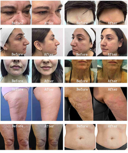 Machine de lifting du visage à succès, remodelage corporel, élimination des cicatrices d'acné et des rides, cartouche Morphus - Product Image 4