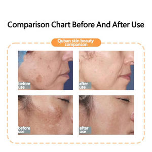 Máquina Profesional de Eliminación de Tatuajes con Pigmento, Eliminación de Manchas de Tatuaje, Analizador de Piel, Directo de Fábrica - Product Image 4