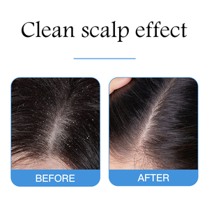 Anti-Dandruff <strong>Shampoo</strong> Targets Oily Scalp and Sheds <strong>Dry</strong> Flakes Clears Away Dandruff Flakes - Product Image 3