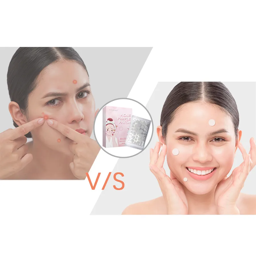 Hydro kolloid Clear Healing Akne Cover Patch Spot Behandlung Korea Pickel Akne Patch