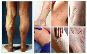 Dispositivo de longitud de onda dual popular para el equipo de Diodelaser de la solución de las venas varicosas del Hospital EVLT - Product Image 6