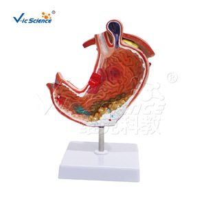 Modèle anatomique gastrique pathologique de grande taille ; outil pédagogique pour l'étude des structures pathologiques de l'estomac humain. - Product Image 5