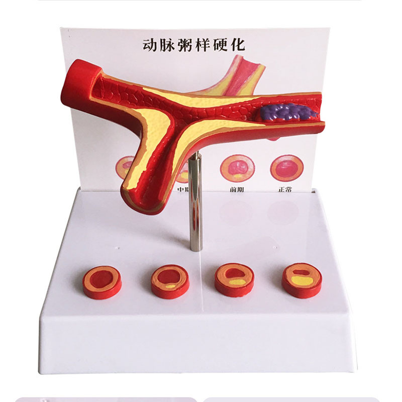 Human Pathological Coronary Artery Cardiovascular Model